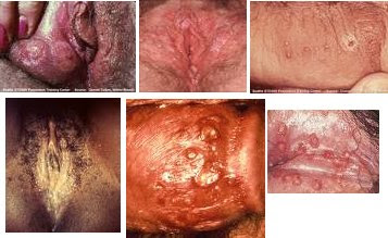Male Genital Herpes